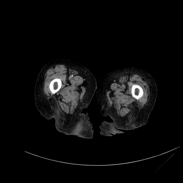 File:Abdominal aortic aneurysm - impending rupture (Radiopaedia 19233-19246 Axial non-contrast 152).jpg