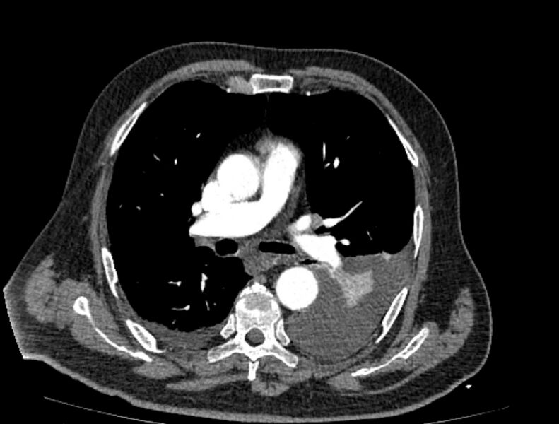 File:Abdominal aortic aneurysm rupture (Radiopaedia 54179-60362 Axial C+ arterial phase 9).jpg