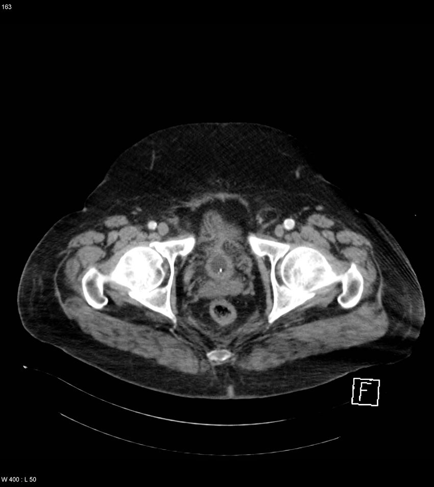 Abdominal aortic aneurysm with intramural hematoma then rupture (Radiopaedia 50278-55632 Axial C+ arterial phase 162).jpg