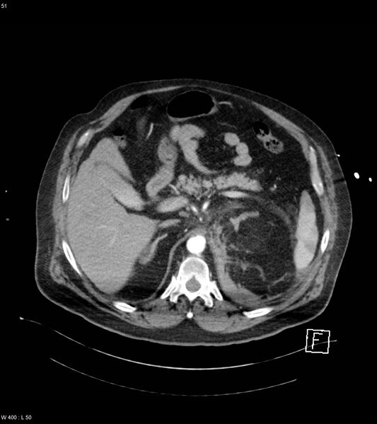 File:Abdominal aortic aneurysm with intramural hematoma then rupture (Radiopaedia 50278-55632 Axial C+ arterial phase 50).jpg