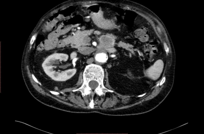 File:Abdominal aortic interposition tube graft and aneurysm thrombosis (Radiopaedia 71438-81857 Axial C+ arterial phase 40).jpg