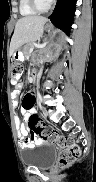 File:Abdominal wall and retroperitoneal tuberculosis (Radiopaedia 88137-104729 Sagittal C+ portal venous phase 66).jpg