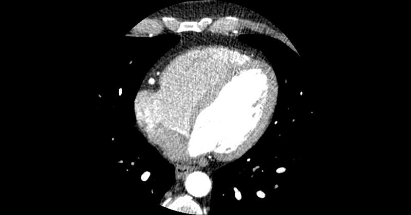 File:Aberrant left main coronary artery (ALMCA) arising from the right sinus with interarterial course (Radiopaedia 63251-71814 Axial C+ arterial phase 125).JPG