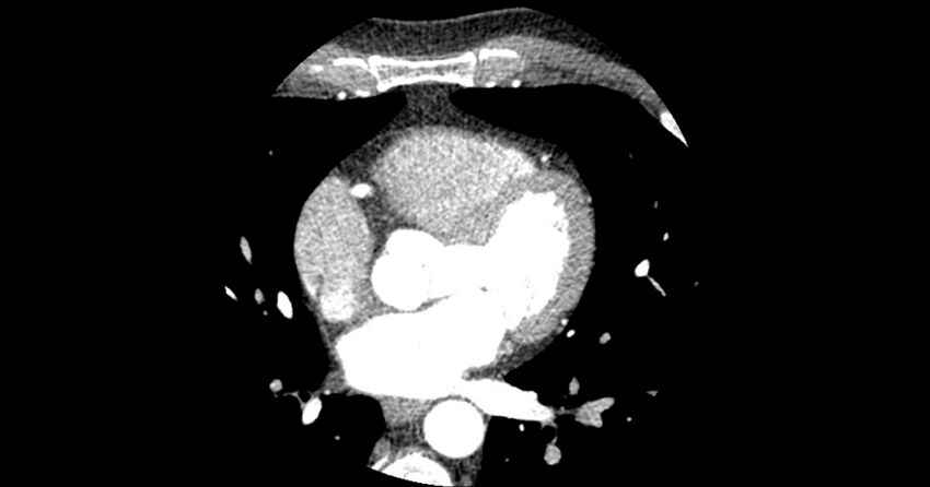 Aberrant left main coronary artery (ALMCA) arising from the right sinus with interarterial course (Radiopaedia 63251-71814 Axial C+ arterial phase 86).JPG