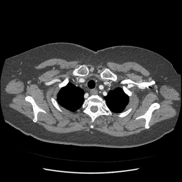 File:Aberrant right subclavian and left vertebral arteries (Radiopaedia 43467-46847 Axial C+ portal venous phase 15).jpg