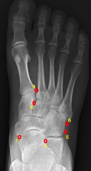 File:Accessory ossicles of the foot (Radiopaedia 42731-45897 B 1).jpg