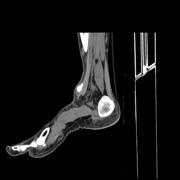 File:Accessory soleus muscle (Radiopaedia 61069-68943 C 36).jpg