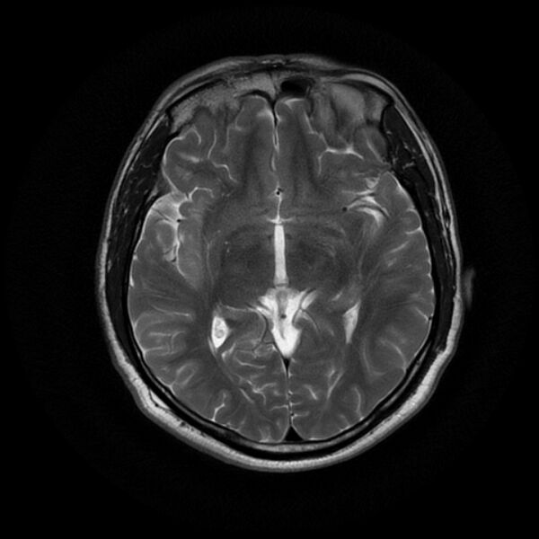 File:Acoustic schwannoma - intracanalicular (Radiopaedia 37247-39024 Axial T2 11).jpg