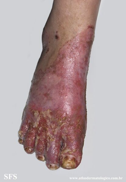 File:Acrodermatitis Enteropathica (Dermatology Atlas 53).jpg