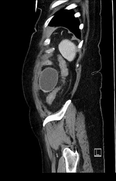 File:Active Crohn disease (Radiopaedia 59394-66750 Sagittal C+ portal venous phase 8).jpg