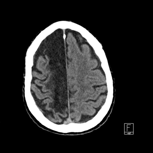 File:Acute ICA ischemic penumbra due to high-grade CCA stenosis (CT perfusion) (Radiopaedia 72038-82529 Axial non-contrast 37).jpg