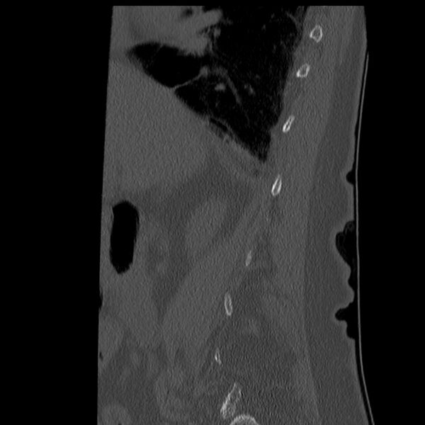 File:Acute and chronic vertebral body fractures (Radiopaedia 31788).jpg