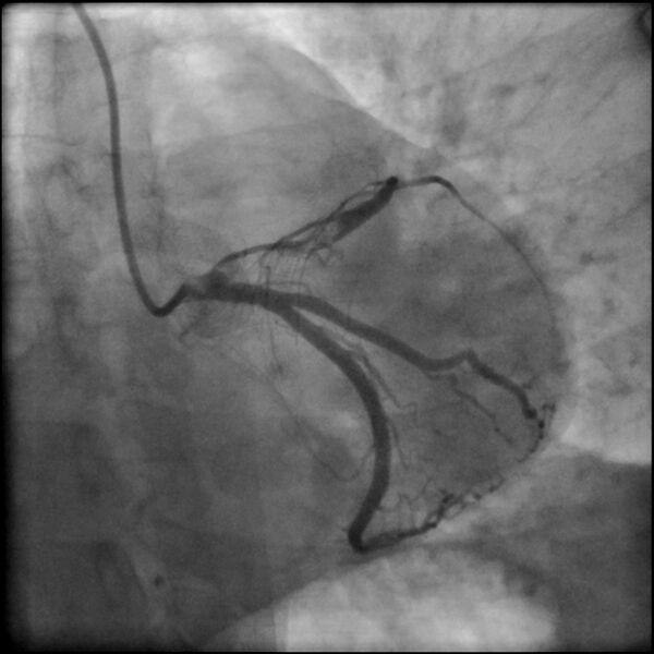 File:Acute anteroseptal myocardial infarction (Radiopaedia 68409-77946 LAO caudal (spider view) LAD and CX 38).jpg