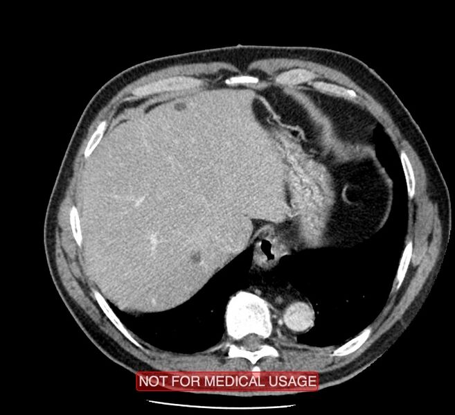 File:Acute aortic dissection - Stanford type A (Radiopaedia 40661-43285 Axial C+ portal venous phase 55).jpg
