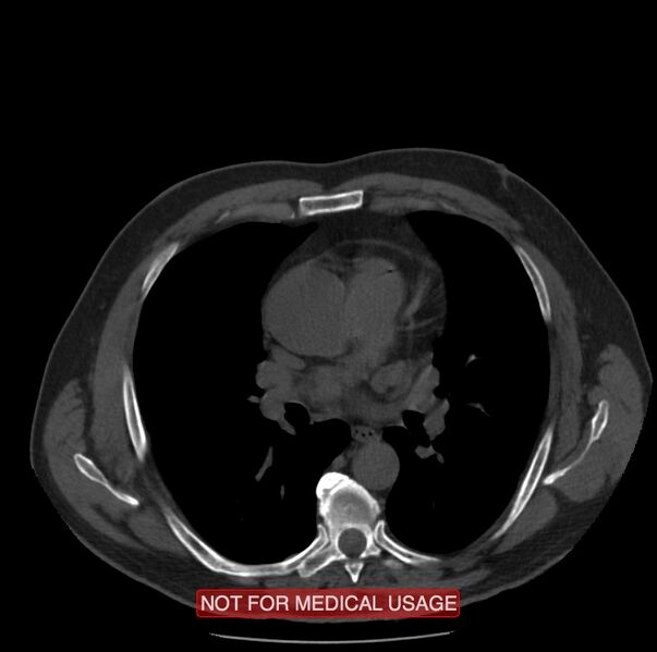 File:Acute aortic dissection - Stanford type A (Radiopaedia 40661-43285 Axial non-contrast 27).jpg