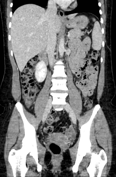 File:Acute appendicitis (Radiopaedia 22892-22918 Coronal C+ portal venous phase 29).png
