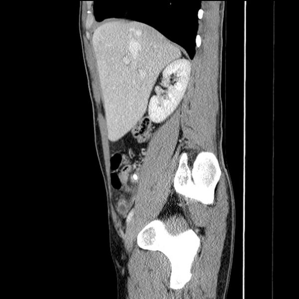 File:Acute appendicitis (Radiopaedia 27049-27227 Sagittal C+ portal venous phase 25).jpg