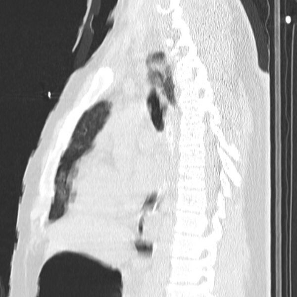 File:Acute aspiration pneumonitis (Radiopaedia 33605-34703 Sagittal lung window 45).jpg