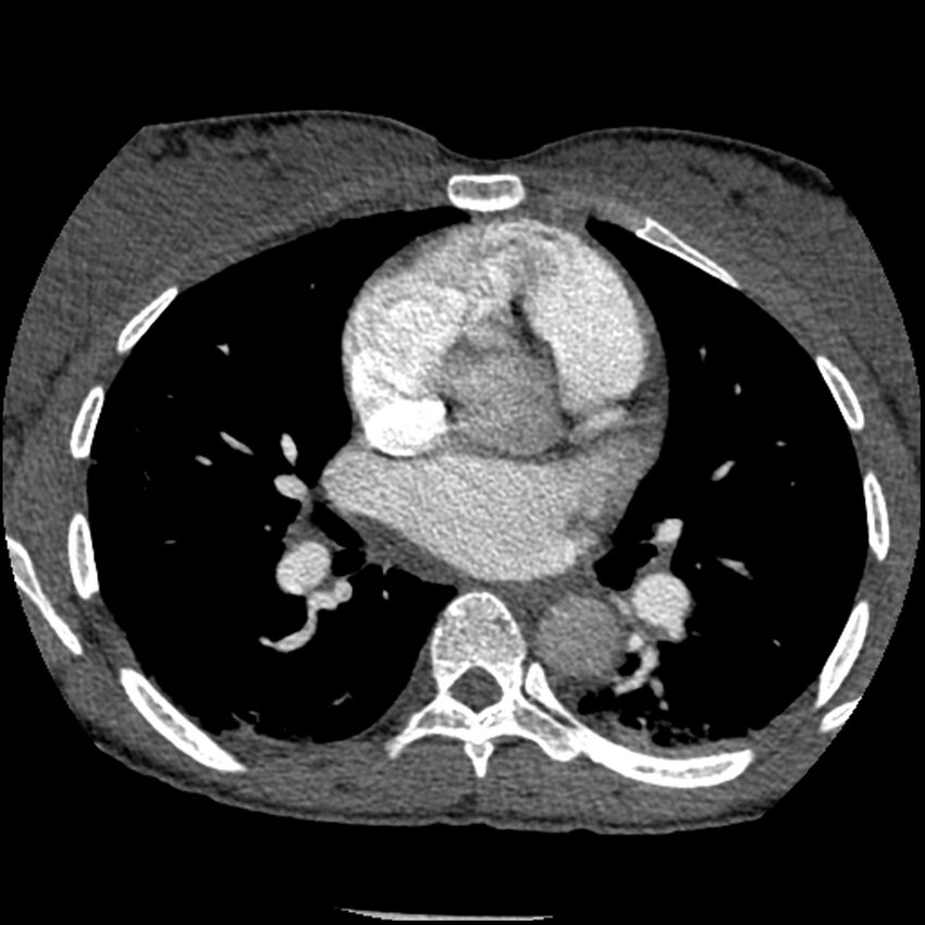 Acute chest syndrome - sickle cell disease (Radiopaedia 42375-45499 Axial C+ CTPA 94).jpg