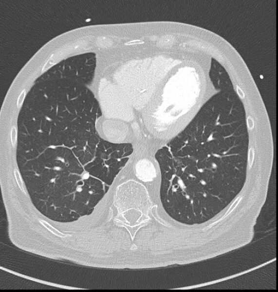 File:Acute myocardial infarction (Radiopaedia 23413-23481 lung window 53).jpg