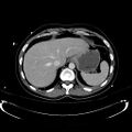 Acute myocardial infarction in CT (Radiopaedia 39947-42415 Axial C+ portal venous phase 23).jpg