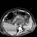 Acute pancreatic necrosis (Radiopaedia 13560-18501 Axial C+ portal venous phase 34).jpg
