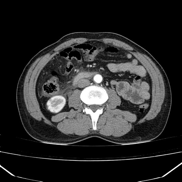 File:Acute pancreatitis (Radiopaedia 22572-22596 Axial C+ arterial phase 41).jpg