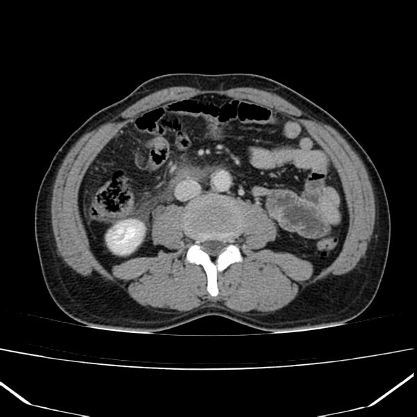File:Acute pancreatitis (Radiopaedia 22572-22596 Axial C+ portal venous phase 39).jpg