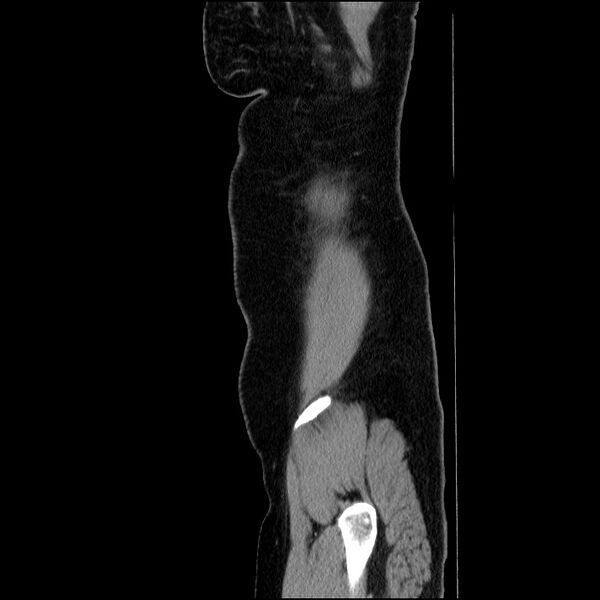 File:Acute pancreatitis (Radiopaedia 69236-79012 Sagittal C+ portal venous phase 16).jpg