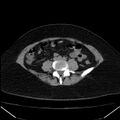 Acute pancreatitis - Balthazar C (Radiopaedia 26569-26714 Axial non-contrast 61).jpg