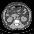 Acute pancreatitis - mild (Radiopaedia 27796-28033 Axial non-contrast 21).jpg