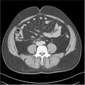 Acute pancreatitis - mild (Radiopaedia 27796-28033 C+ portal venous phase 38).jpg