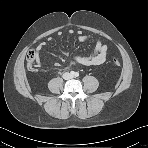 File:Acute pancreatitis - mild (Radiopaedia 27796-28033 C+ portal venous phase 38).jpg