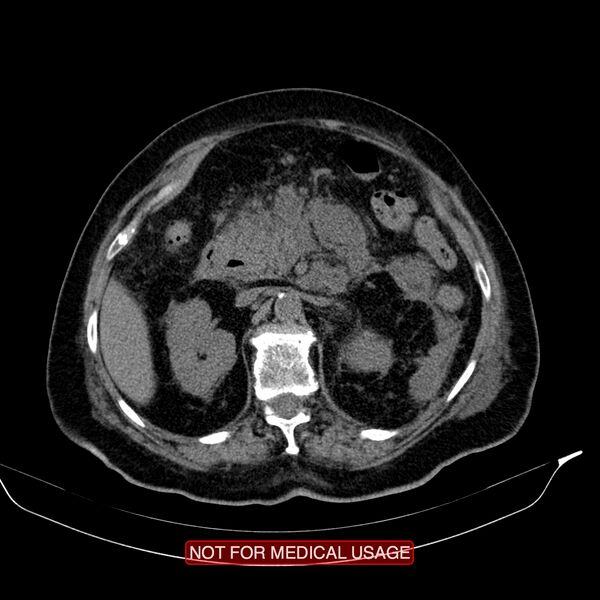 File:Acute pancreatitis with infected necrosis (Radiopaedia 26454-26585 Axial non-contrast 12).jpg