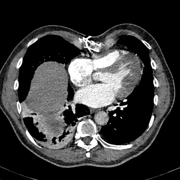 File:Acute pulmonary embolism (Radiopaedia 81677-95570 Axial C+ CTPA 77).jpg