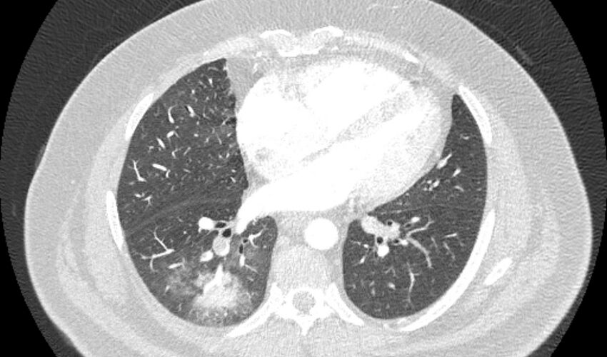 Acute pulmonary embolism with pulmonary infarcts (Radiopaedia 77688-89908 Axial lung window 77).jpg