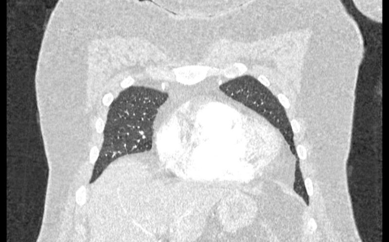File:Acute pulmonary embolism with pulmonary infarcts (Radiopaedia 77688-89908 Coronal lung window 7).jpg