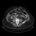Acute pyelonephritis (Radiopaedia 25657-25837 Axial renal parenchymal phase 51).jpg