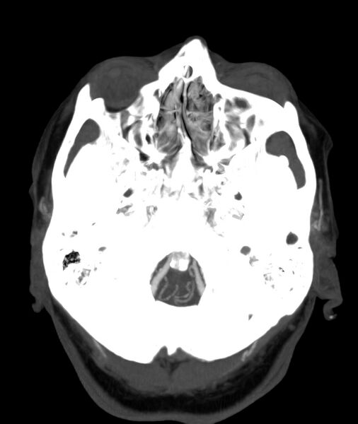 File:Acute right MCA M1 occlusion (Radiopaedia 62268-70454 Axial Phase 1 28).jpg