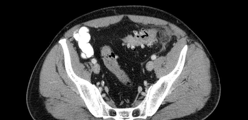 Acute sigmoid colon diverticulitis (Radiopaedia 55507-61976 Axial C+ portal venous phase 87).jpg