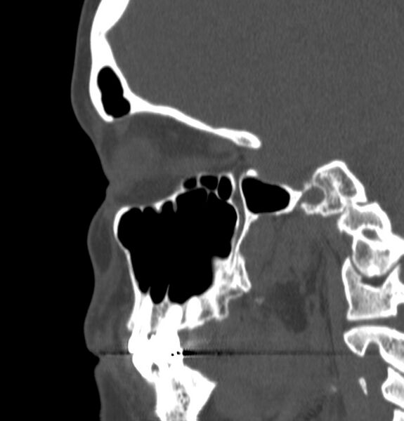 File:Acute sinusitis (Radiopaedia 22419-22455 Sagittal non-contrast 8).jpg