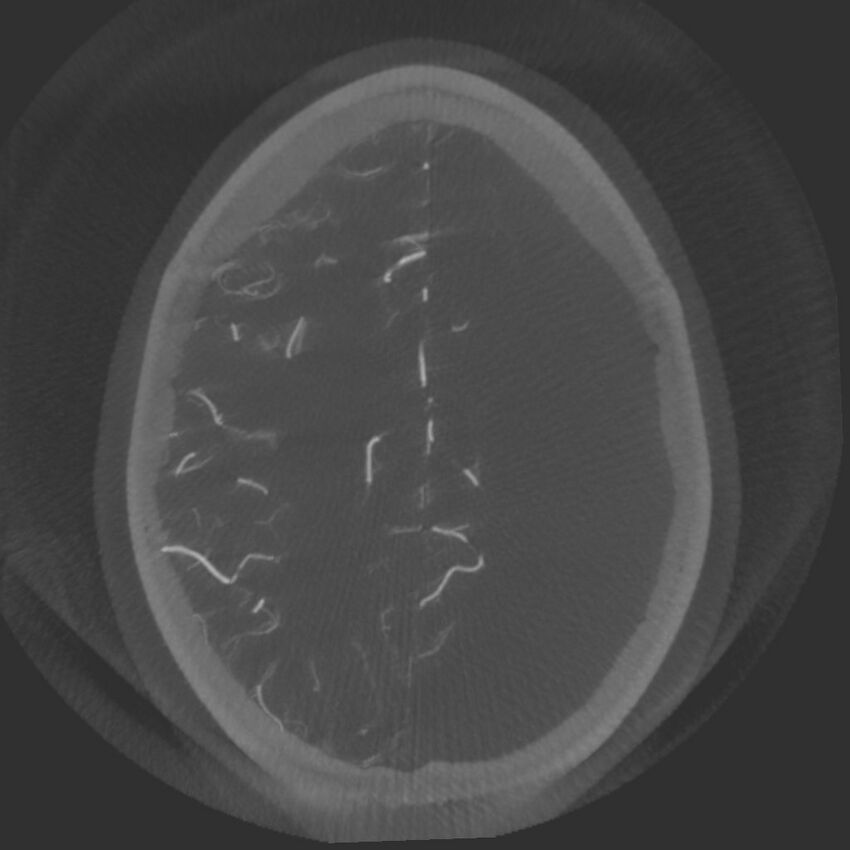 Acute subarachnoid hemorrhage and accessory anterior cerebral artery (Radiopaedia 69231-79010 Axial arterial - MIP 63).jpg
