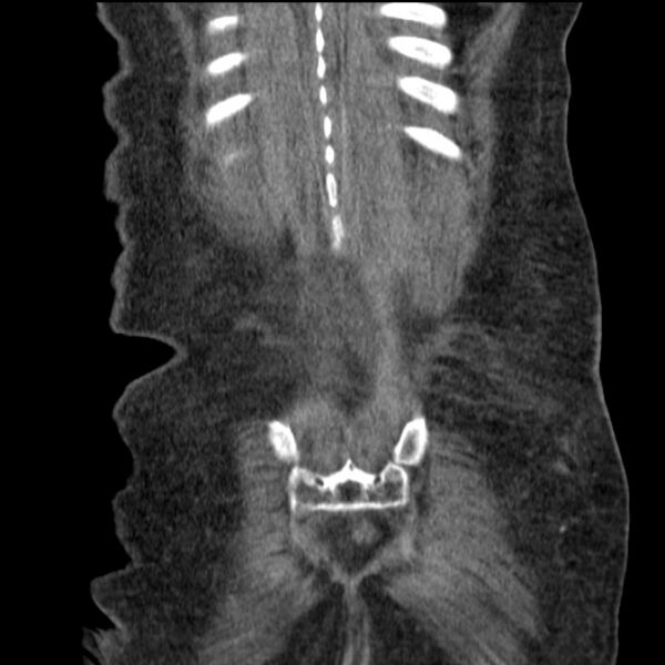 File:Acute tubular necrosis (Radiopaedia 28077-28334 G 74).jpg