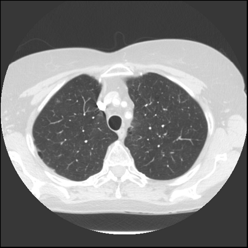 Adenocarcinoma of the lung (Radiopaedia 41015-43755 Axial lung window 28).jpg