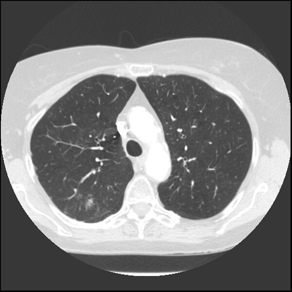 File:Adenocarcinoma of the lung (Radiopaedia 41015-43755 Axial lung window 37).jpg