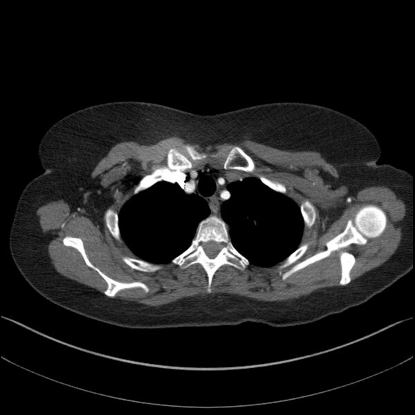File:Adenocarcinoma of the lung (Radiopaedia 44205-47803 Axial C+ portal venous phase 13).jpg
