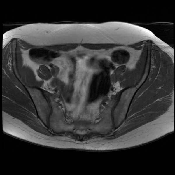 File:Adenoma malignum of the cervix (Radiopaedia 24460-24765 T1 5).jpg