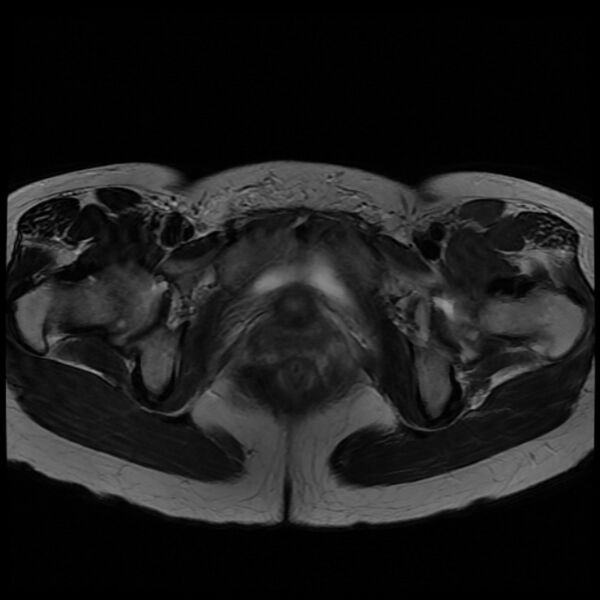 File:Adenomyosis on MRI (Radiopaedia 29328-29780 Axial T2 11).jpg