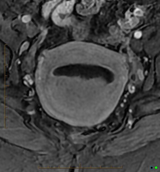 File:Adenomyosis uterus with hematometra (Radiopaedia 45779-50011 Axial T1 C+ fat sat 29).jpg