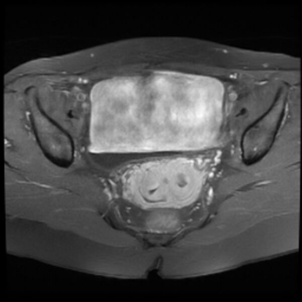 File:Adenomyosis within a septate uterus (Radiopaedia 69963-79981 Axial T1 C+ fat sat 16).jpg